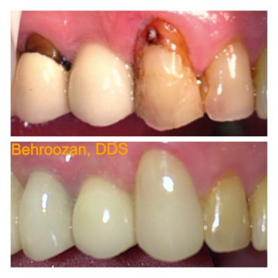 Cosmetic Fillings