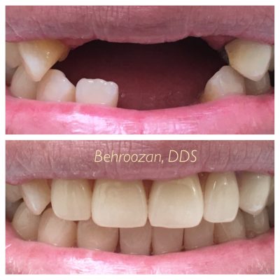 Dentures