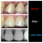 crowns-and-veneers-20-400x400-1.jpg