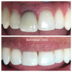 crowns-and-veneers-40-400x400-1.jpg