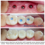 implant-400x437-1.jpg