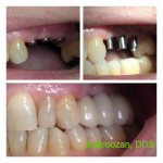 implants-01-400x400-1.jpg