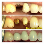 implants-02-400x400-1.jpg