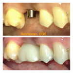 implants-03-400x400-1.jpg