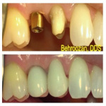 implants-04-400x267-1.jpg