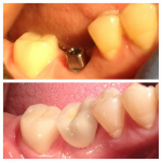 implants-05-400x400-1.jpg