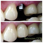 implants-06-400x400-1.jpg