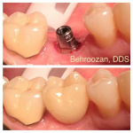 implants-07-400x400-1.jpg