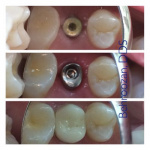 implants-08-400x400-1.jpg