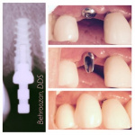 implants-09-400x400-1.jpg