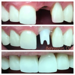 implants-10-400x400-1.jpg