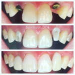 implants-11-400x400-1.jpg