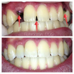 implants-12-400x400-1.jpg