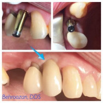 implants-13-400x400-1.jpg