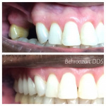 dentures-07-400x400.jpg