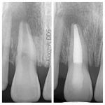 root-canals-01-400x400-1.jpg