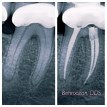 root-canals-02-400x400-1.jpg