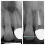 root-canals-03-400x400-1.jpg