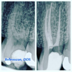 root-canals-04-400x400-1.jpg