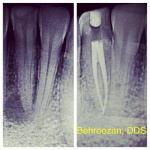 root-canals-05-400x400-1.jpg