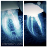 root-canals-06-400x400-1.jpg